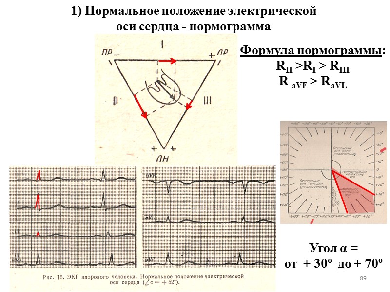 89 1) Нормальное положение электрической  оси сердца - нормограмма Формула нормограммы: RII >RI